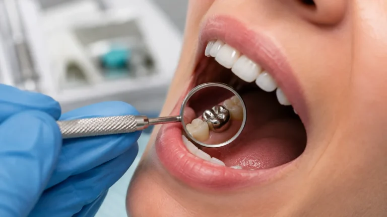 Dentiste examinant une couronne métallique sur une molaire à l’aide d’un miroir dentaire.