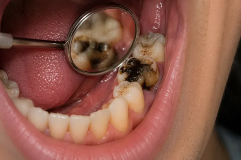 Dent pourrie avec carie profonde examinée par un chirurgien-dentiste